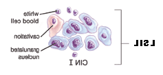 Illustration of LSIL cells.